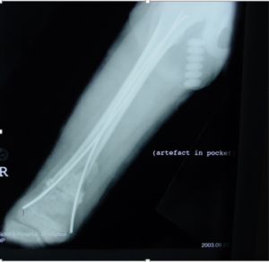 Figure 2: Plain radiograph of an inappropriately managed pathological fracture secondary to osteosarcoma making limb salvage very challenging.