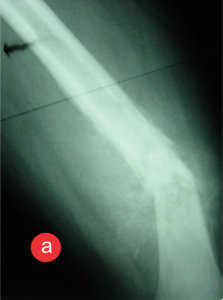 Figure 3A: Radiograph showing a pathological fracture secondary to osteosarcoma.