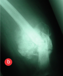 Figure 3B: Radiograph showing post chemotherapy consolidation in the pathological fracture.