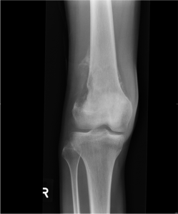 Figure 1A: Anteroposterior radiograph of the right knee demonstrating a gross cortical breach at the lateral aspect of the distal metaphysis. 