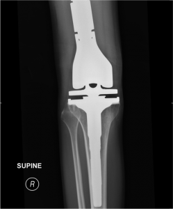 Figure 1B: Anteroposterior radiograph showing the defect reconstructed with a rotating-hinge Global Modular Reconstructive System (GMRS) prosthesis.