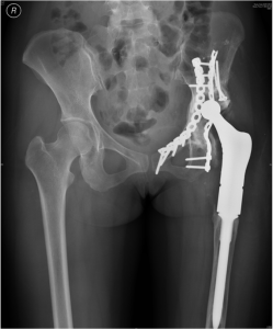 Figure 2A: Anteroposterior radiograph of the pelvis 6 years after pelvic osteosarcoma removal and reconstruction of the proximal femur. 