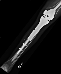 Figure 3B: Anteroposterior radiograph showing megaprosthetic reconstruction after proximal tibia osteosarcoma excision. 