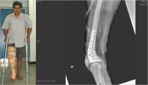 Figure 4: Hinge knee brace following bone graft.