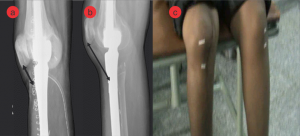 Figure 3: a) Patella position following proximal tiabia and knee joint replacement b) Patellar tendon stretch after 3months c) Patella mal position (over ride) on patient.