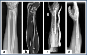 Figure 3: Ulnar translocation (a,b) Plain radiograph and MRI showing the osteosarcoma of distal radius.(c) Immediate post operative radiograph shows the ulna in the distal radius defect and wrist arthrodesis. (d) Union at both radio-ulna and carpal-ulna junction after 3 months of surgery. 