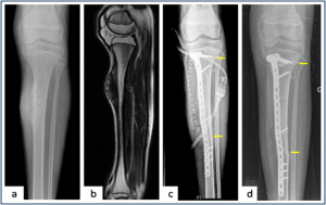 Figure 4: Intercalary resection and extra-corporeal radiotherapy ( a,b) Plain radiograph and MRI showing the periosteal osteosarcoma of tibia. (c) Plain radiograph showing Intercalary resection of the tibia. Resected bone was irradiated and stabilised in the defect with Locking plate. Arrows showing osteotomy sites (d) Union at both metaphysical and diaphyseal osteotomy ( arrows) site after 9 months of follow up.