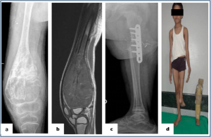 Figure 5: : Rotationplasty (a,b) Plain radiograph and MRI showing the osteosarcoma of the distal femur in a skeletally immature patient. (c) Plain radiography showing the union between femur and tibia after 3 months of surgery. (d) Clinical picture showing rotationplasty patient with externally rotated foot and prosthesis used for the same